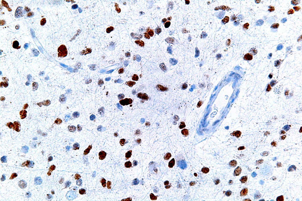 Imagen: Una microfotografía que muestra células con una expresión anormal de p53 (marrón) en un tumor cerebral (Fotografía cortesía de Wikimedia Commons).