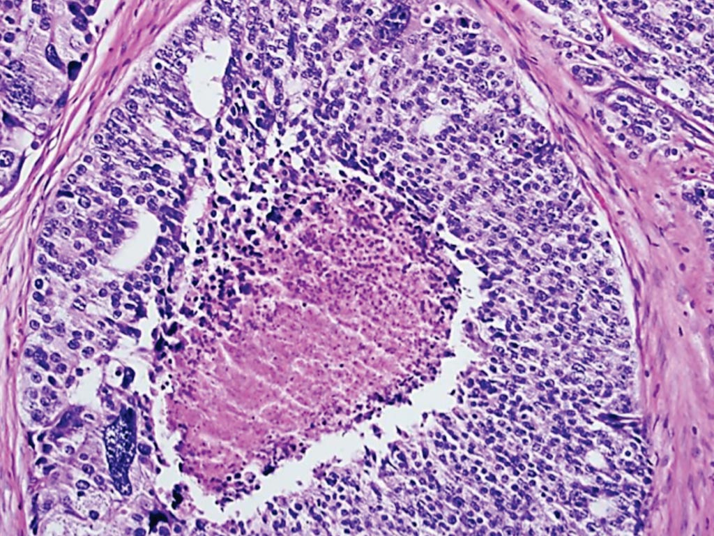 Imagen: Una histopatología del cáncer de próstata - La presencia de necrosis luminal en un comedón, en un espacio glandular del cáncer, es suficiente para diagnosticar el grado 5 de Gleason (Fotografía cortesía de Kenneth Iczkowski, MD).