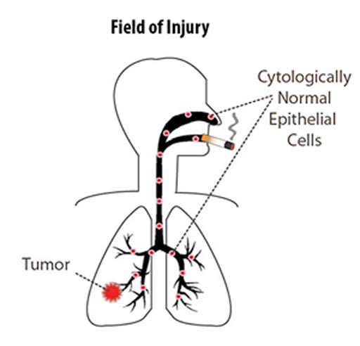 Imagen: Un diagrama que muestra que el campo de lesión del cáncer de pulmón se extiende mucho más allá del tumor. Una nueva investigación demuestra cambios genéticos presentes en las células nasales de los pacientes que desarrollaron cáncer de pulmón (Fotografía cortesía de Avrum Spira, Centro Médico de la Universidad de Boston).