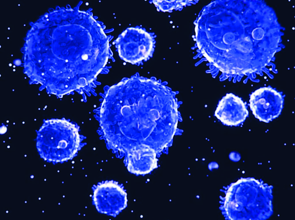 Imagen: En la leucemia linfoide aguda, los glóbulos blancos se desarrollan de manera anormal y no pueden combatir la infección de manera integral (Fotografía cortesía del Profesor Stephen Francis).