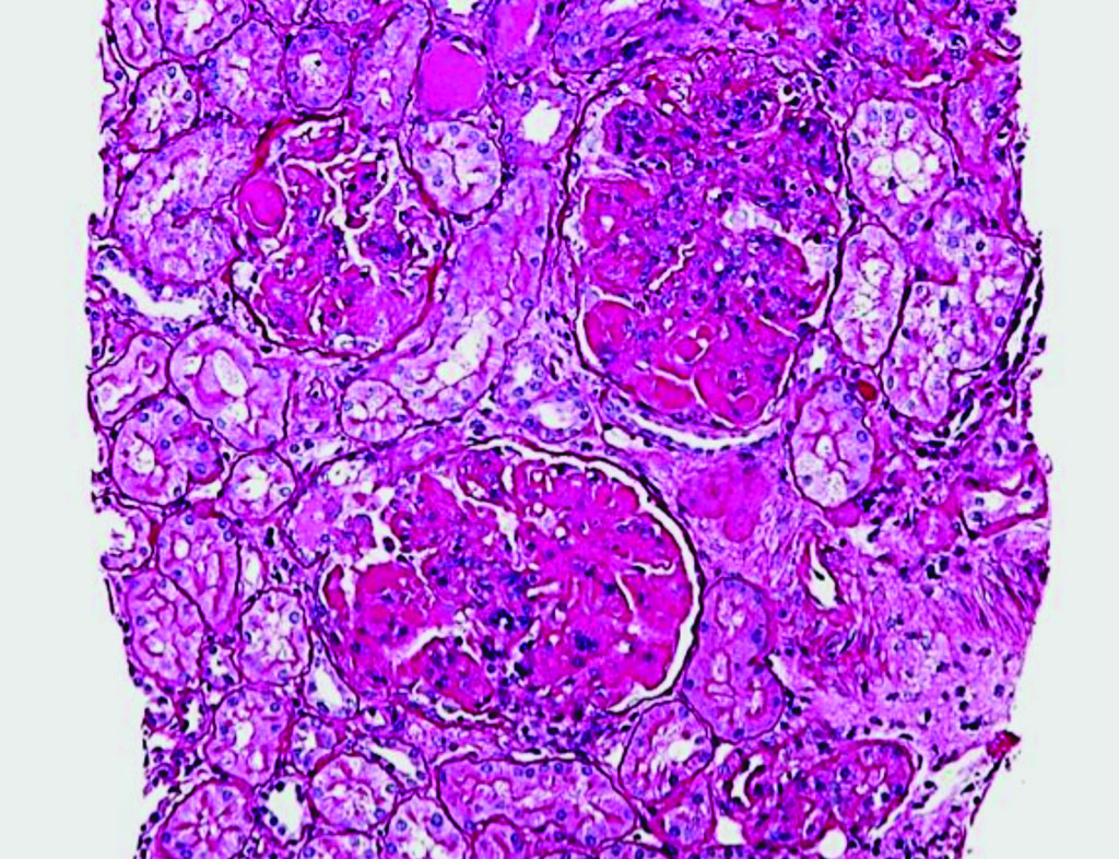 Imagen: Una histopatología de una biopsia de riñón mostrando nefritis lúpica proliferativa, difusa, con aumento de la matriz mesangial e hipercelularidad mesangial (Fotografía cortesía de Nephron).