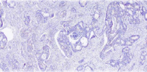 Imagen: Una vista microscópica de un corte de cáncer de colon (Fotografía cortesía del Instituto de Investigación Biomédica IDIBELL-Bellvitge).