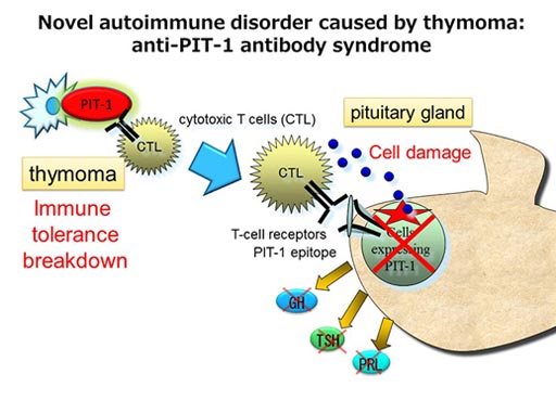 Imagen: El factor de transcripción pituitario específico, PIT-1, desempeña un papel esencial en la producción de la hormona del crecimiento (GH), la hormona estimulante del tiroides (TSH) y la prolactina (PRL). Los investigadores han descubierto que se detectó un timoma en los casos examinados de “síndrome de anticuerpo anti-PIT-”. La expresión de PIT-1 se incrementó anormalmente dentro del timoma y esto probablemente evocó la ruptura de la tolerancia inmunitaria y el hipopituitarismo que se produce en pacientes con este trastorno autoinmune (Fotografía cortesía de la Universidad de Kobe).
