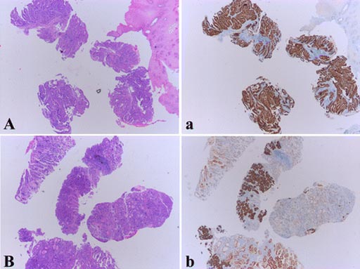 Imagen: Coloración de inmunohistoquímica (IHC) del receptor 2 del factor de crecimiento epidérmico humano (HER2), en muestras de biopsia que muestran homogeneidad y heterogeneidad intratumoral (Fotografía cortesía de la Universidad de Fudan).