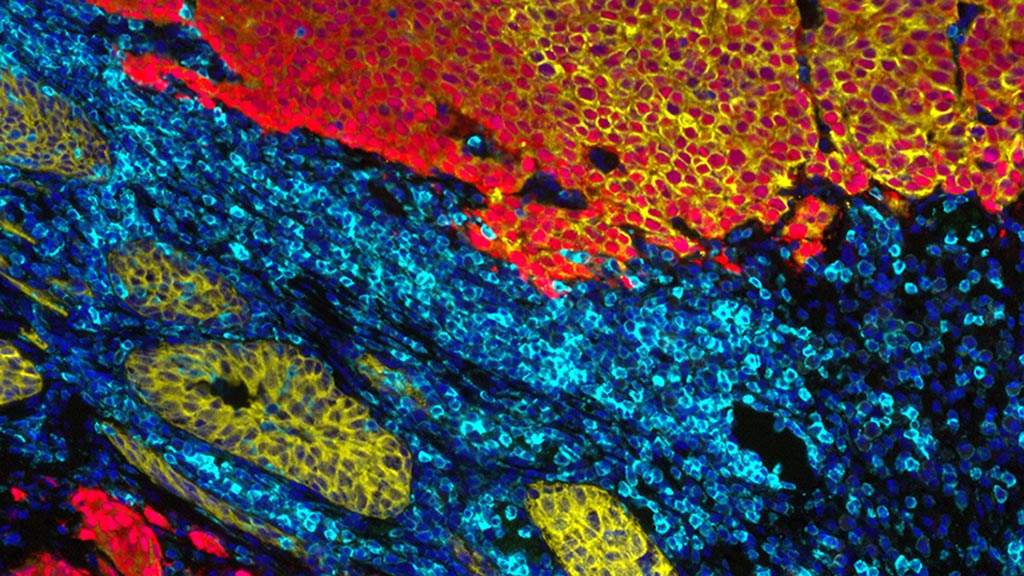 Imagen: Coloración de inmunofluorescencia mostrando la extensión del adenocarcinoma prostático a la pared de la vejiga en una próstata resistente a la castración (Fotografía cortesía del Instituto de Investigación del Cáncer).