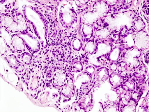 Imagen: Una imagen histopatológica de la infiltración linfoide focal en la glándula salival secundaria asociada con el síndrome de Sjögren (Fotografía cortesía de Wikimedia).