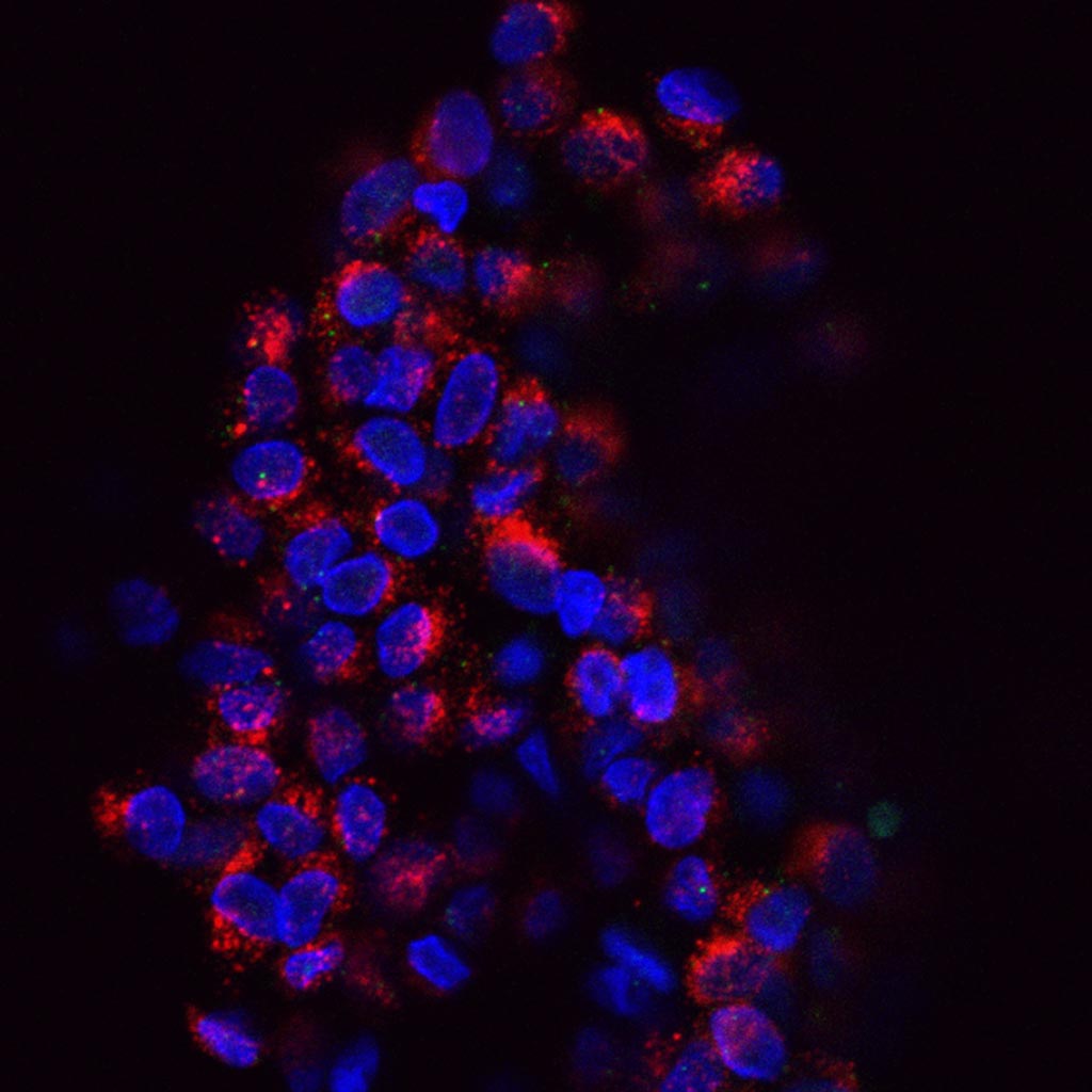 Imagen: Un grupo de células tumorales circulantes (CTC, mostradas en rojo) presentes en la sangre de una paciente con cáncer de mama (Fotografía cortesía del NIH).