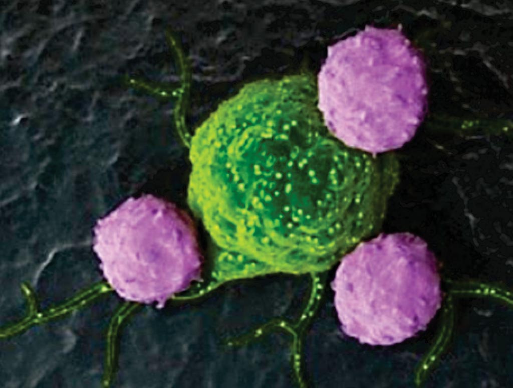 Imagen: Una microfotografía electrónica de barrido (SEM) que muestra los linfocitos T que rodean una célula de cáncer de mama. La prueba de los \'puntos calientes\' inmunes puede predecir el riesgo de que el cáncer de mama haga recurrencia (Fotografía cortesía de Sebastian Kaulitzki.