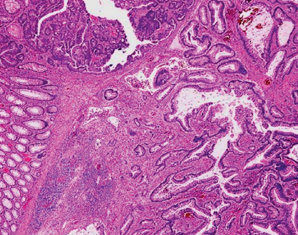 Imagen: Un corte histológico de un adenoma de colon que contiene un carcinoma invasivo (Fotografía cortesía del Dr. Mauro Risio).