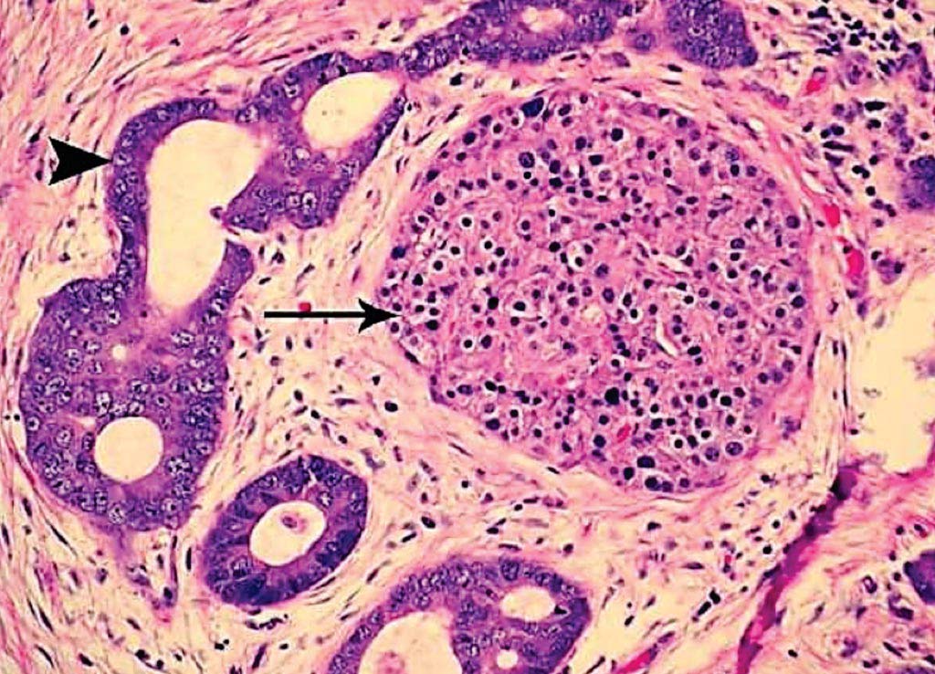 Imagen: Una histopatología del adenocarcinoma ductal pancreático. Un adenocarcinoma moderadamente diferenciado muestra el rodeo de los islotes y de una desmoplasia estromal. La desmoplasia se manifiesta por el estroma fibromixoide con un arreglo al azar de las células (Fotografía cortesía de Pathpedia).