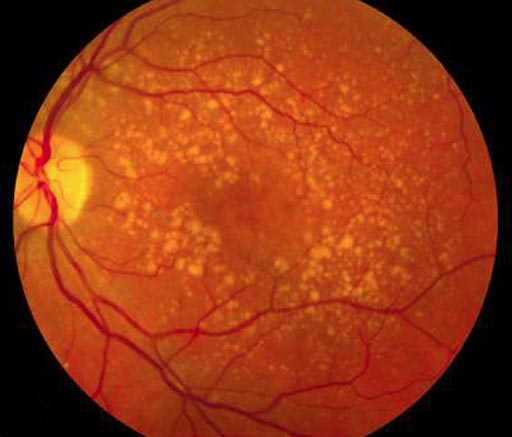 Imagen: La parte posterior del ojo en un paciente con degeneración macular relacionada con la edad (DMAE), mostrando múltiples depósitos drusen grandes y cambios en el pigmento (Fotografía cortesía del Massachusetts Eye and Ear Infirmary).