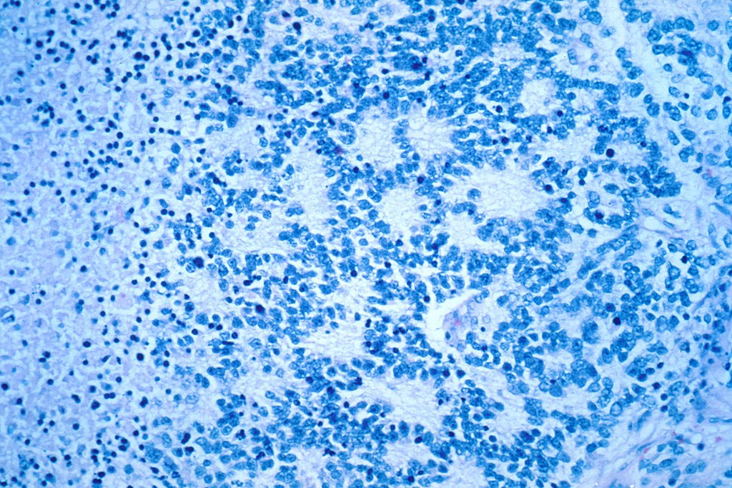 Imagen: Una fotomicrografía de un neuroblastoma típico con formación de rosetas (Fotografía cortesía del Instituto Nacional del Cáncer de Estados Unidos).