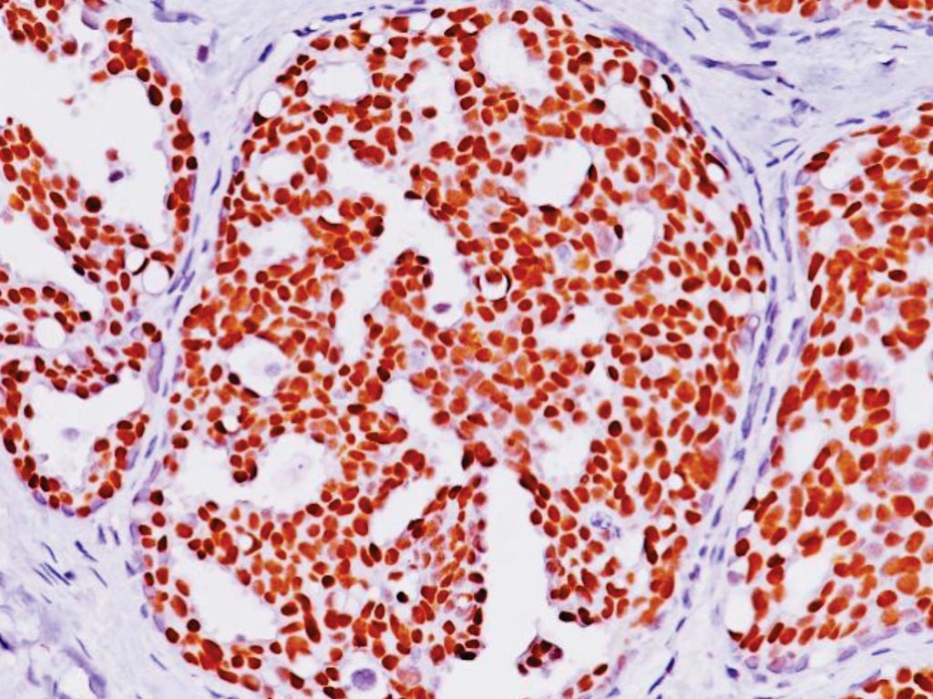Imagen: Inmunohistoquímica del cáncer de mama positivo para los receptores de estrógeno (ER (+)) (Fotografía cortesía de Biocare Medical).