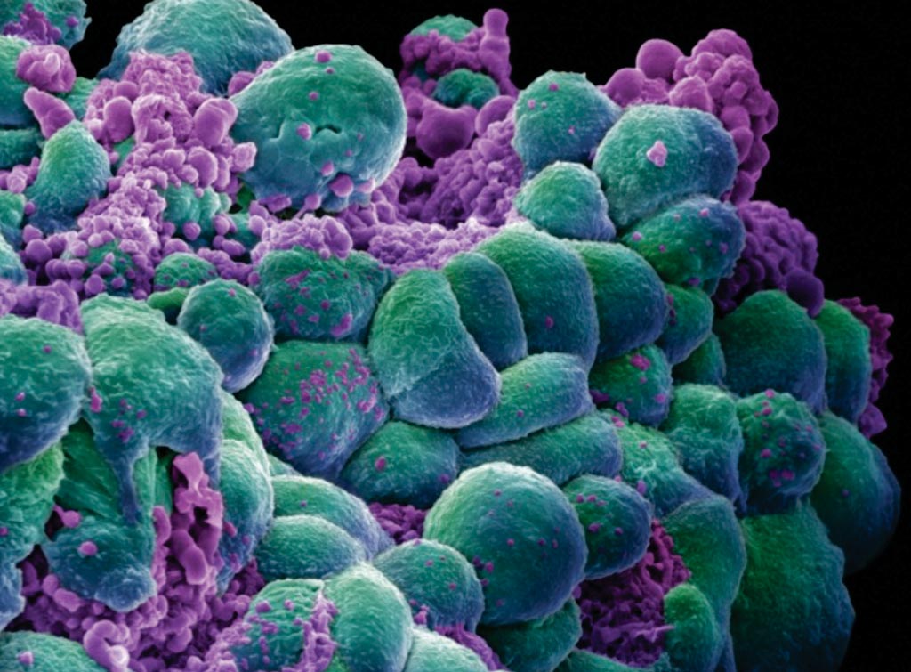 Imagen: Una micrografía electrónica de barrido (SEM) de células de cáncer de mama (Fotografía cortesía de SPL).