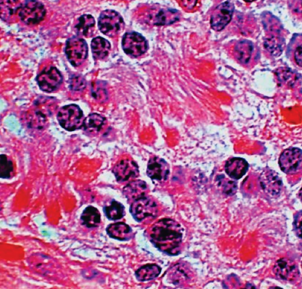 Imagen: Histopatología de un retinoma que muestra florecillas abundantes y células dispersas con citoplasma eosinófilo. Los retinomas comparten el mismo origen genético que los retinoblastomas (Fotografía cortesía de Helen Dimaras, PhD).