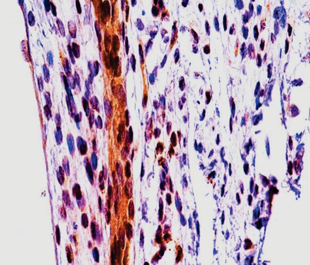 Imagen: Un corte histológico que muestra un conducto biliar extrahepático obstruido. Exhibe la expresión residual de la enzima llamada MMP-7 (se muestra en color marrón) (Fotografía cortesía del Centro Médico del Hospital Infantil de Cincinnati).