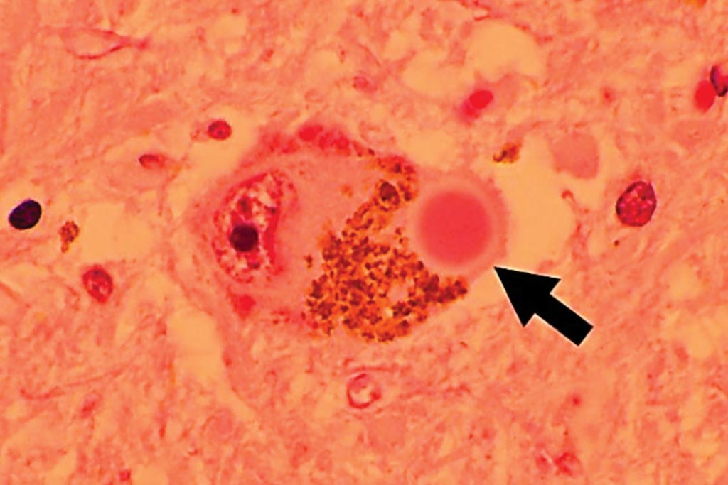 Imagen: Una histopatología de la inclusión denominada cuerpo de Lewy (flecha) en una neurona pigmentada de la sustancia negra ubicada en el cerebro medio (Fotografía cortesía de la Clínica Cleveland).
