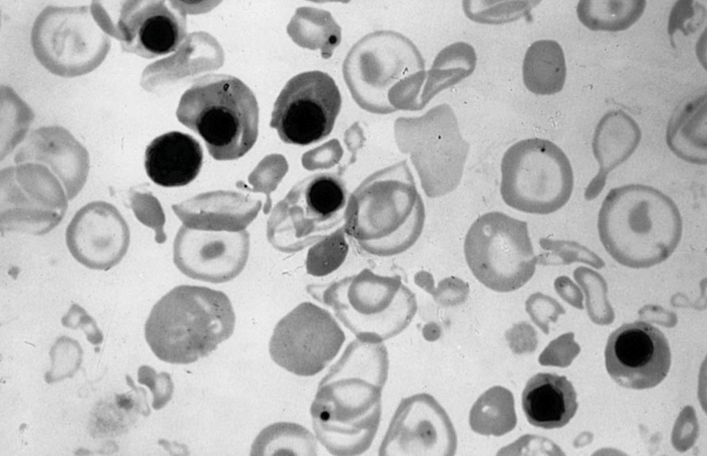 Imagen: Extendido de sangre periférica de un recién nacido con hidropesía fetal; nótese la hipocromía, los cambios anisopoiquilocíticos y la eritroblastosis (Fotografía cortesía del Centro Médico Boston).