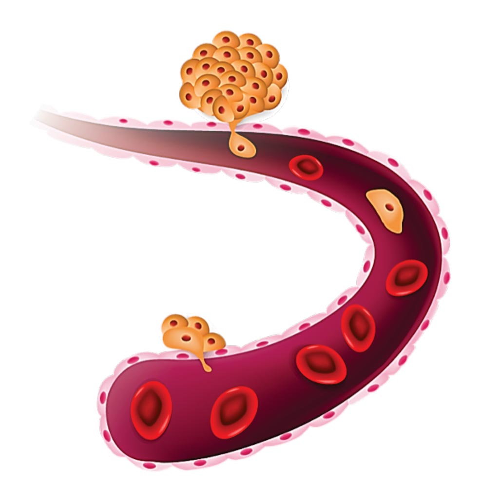 Imagen: Representación de las células tumorales circulantes que se desprenden de un tumor primario y circulan por el torrente sanguíneo (Fotografía cortesía de CellMax Life).