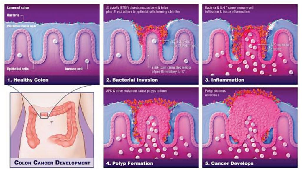 Imagen: Diagrama de la forma cómo las bacterias juegan un papel crítico en el desarrollo del cáncer de colon (Fotografía cortesía de Elizabeth Cook).