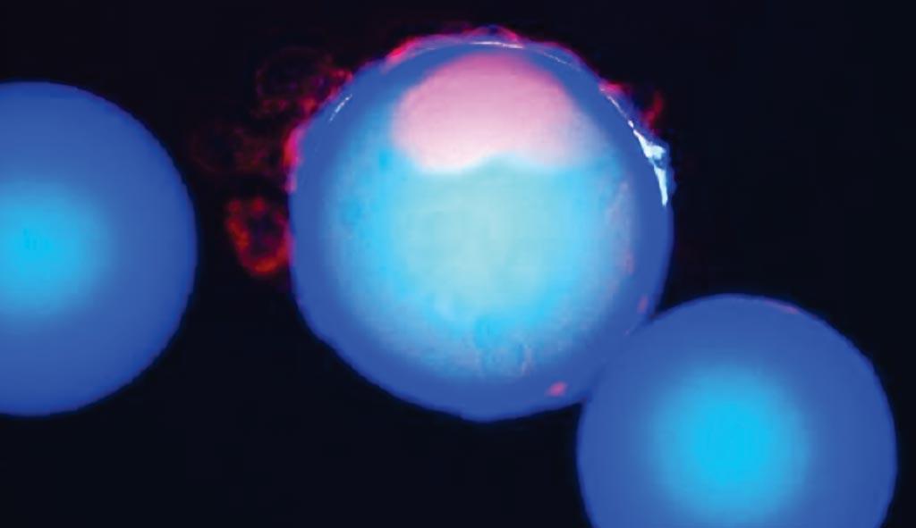 Imagen: Una nueva técnica para aislar las células madre cancerosas: se usaron 40,000 perlas pequeñas de plástico (azul), cada una recubierta con un compuesto químico único, para identificar un compuesto que se une solamente a las células madre del cáncer de mama (rojo) (Fotografía cortesía de la Universidad de Texas en Dallas).