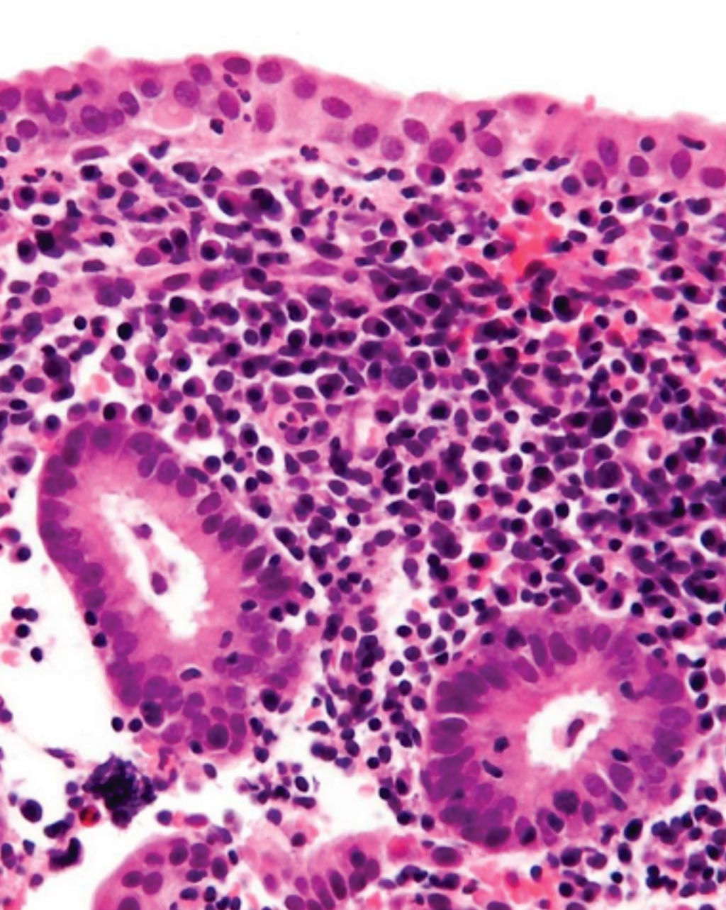 Imagen: Una micrografía histológica que muestra el endometrio con células plasmáticas abundantes, que son diagnósticas para la endometritis crónica y con neutrófilos dispersos (Fotografía cortesía de Nephron).
