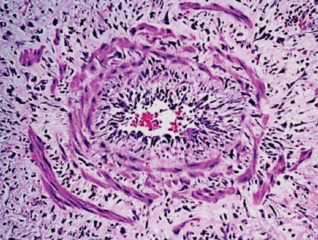 Imagen: Histopatología de un infiltrado inflamatorio de vena profunda con la pared disociada por el edema, observada en una lesión cutánea de un paciente con lepra que padece un episodio de eritema nodoso leproso (Fotografía cortesía del Instituto Oswaldo Cruz).