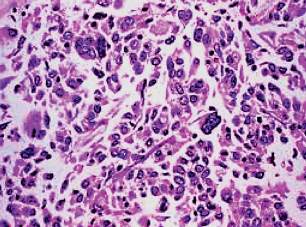 Imagen: Una micrografía de la histopatología de un carcinoma anaplásico de tiroides (Fotografía cortesía del Centro de Cáncer de Tiroides Clayman).