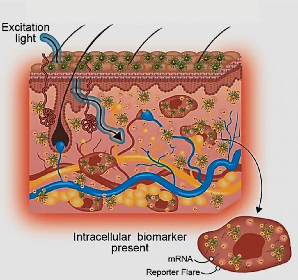 Imagen: Un diagrama de la simplificación del diagnóstico de la enfermedad aplicando nanotecnología tópicamente podría cambiar la forma en que se diagnostican y se manejan las enfermedades de la piel, como las cicatrices anormales (Fotografía cortesía de la Universidad Tecnológica de Nanyang).