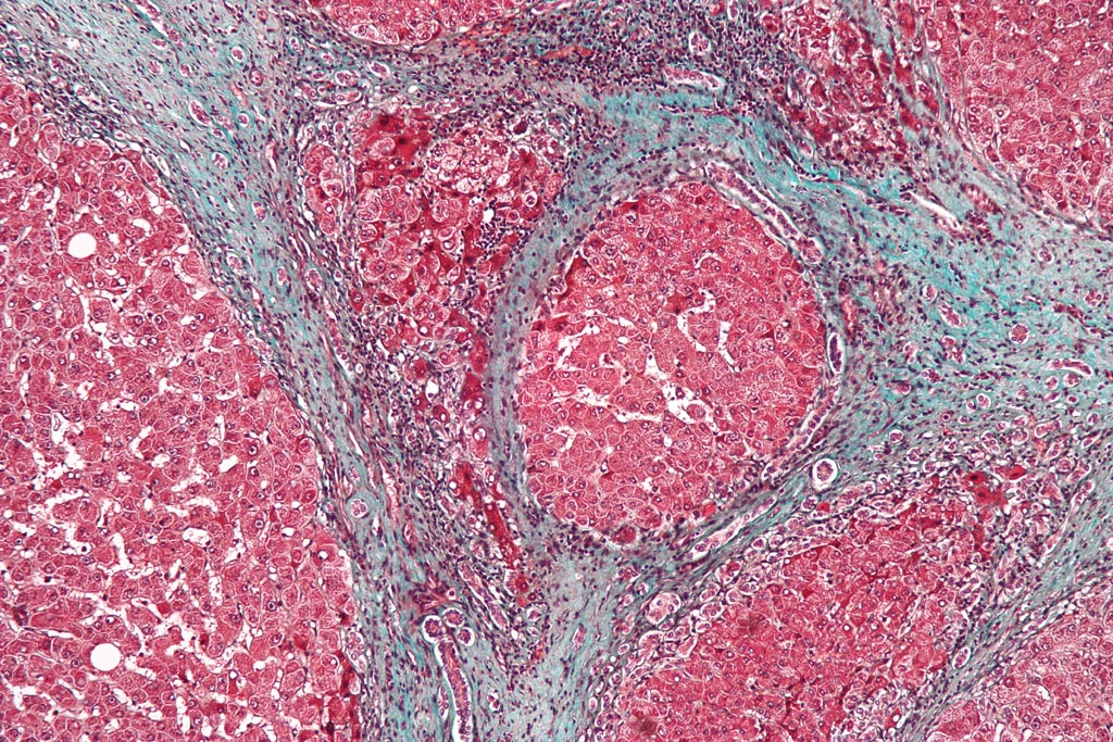 Imagen: Una micrografía que muestra la cirrosis hepática. El tejido en este ejemplo se tiñe con una coloración tricrómica, en la que la fibrosis es de color azul. Las áreas rojas son el tejido nodular del hígado (Fotografía cortesía de Wikimedia Commons).