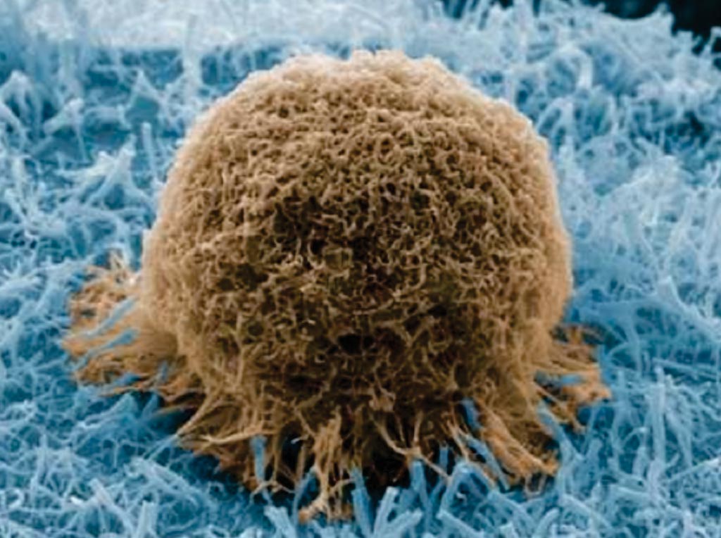 Imagen: Una microfotografía electrónica de barrido (SEM) de una célula de cáncer de próstata capturada en una lámina esmerilada con nanocables de sílice (Fotografía cortesía de la Sociedad Americana de Química).