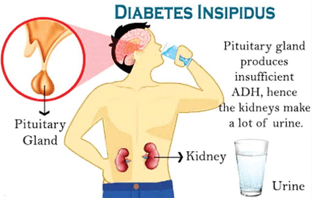 Imagen: Un diagrama de las causas de la diabetes insípida resultante de la falta de producción de vasopresina (ADH) en el hipotálamo o en la glándula pituitaria (Fotografía cortesía de Maria Khatun Mona, RN).