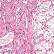 Imagen: Una micrografía del tipo más común de carcinoma de células renales (células claras) a la derecha de la imagen; el riñón no tumoral está a la izquierda de la imagen (Fotografía cortesía de Wikimedia Commons).