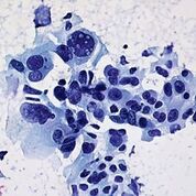 Imagen: Una histopatología del cáncer de pulmón no microcítico obtenida de un aspirado con aguja fina que muestra una marcada variación en el tamaño y forma de los núcleos, cromatina nuclear de distribución irregular y nucléolos grandes y prominentes (Fotografía cortesía de Ed Uthman, MD).