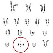 Imagen: La determinación del cariotipo de la trisomía 21 en una mujer: hay un conjunto completo de 23 pares de autosomas homólogos, pero un cromosoma 21 adicional (Fotografía cortesía del Dr. Daniel Closa).