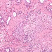 Imagen: Una micrografía que muestra la inflamación granulomatosa del tejido del cuello de la vejiga debido al Bacilo de Calmette-Guérin (BCG) utilizado para tratar el cáncer de vejiga (Fotografía cortesía de Wikimedia Commons).