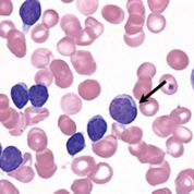Imagen: Un extendido de sangre de un paciente con leucemia linfoide crónica (LLC); un linfocito grande (flecha) tiene un núcleo con muescas y demuestra la apariencia variable de algunos de los linfocitos en la LLC (Fotografía cortesía de Peter Maslak).