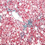 Imagen: Una micrografía de la enfermedad del hígado graso no alcohólico, que demuestra una esteatosis marcada (el hígado graso aparece blanco) (Fotografía cortesía de Wikimedia Commons).