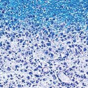 Imagen: Reducción de las vainas de mielina: las áreas dañadas (en la parte inferior de la imagen) de los cerebros de los pacientes con EM carecen de mielina (en la parte superior, en azul) (Fotografía cortesía del Dr. med. Imke Metz, Universidad de Göttingen).