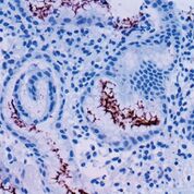 Imagen: Coloración inmunohistoquímica de Helicobacter pylori en tejido de estómago infectado fijado en formol e incluido en parafina (FFPE) (Fotografía cortesía de Bio SB).