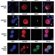 Imagen: Células tumorales diseminadas (DTC) coloreadas por doble inmunofluorescencia (AE1AE3/NR2F1 y AE1AE3/Ki67) y correlación entre la expresión de Ki67 y NR2F1 (Fotografía cortesía de la Facultad de Medicina Icahn en el Hospital Monte Sinaí).