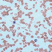 Imagen: Una fotomicrografía de células falciformes en la sangre humana: se ve la presencia tanto de los glóbulos rojos normales como de las células con forma de hoz (Fotografía cortesía del Dr. Graham Beards).
