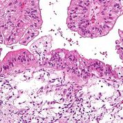 Imagen: Una micrografía de un carcinoma de ovario mucinoso (Fotografía cortesía de Wikimedia Commons).