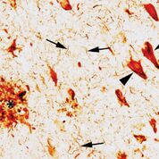 Imagen: Un corte del hipocampo de un paciente con enfermedad de Alzheimer coloreado con un anticuerpo anti tau (TNT1). Observe la tríada clásica de las patologías tau en la EA, 1) ovillos neurofibrilares (puntas de flecha), 2) hilos de neuropil (flechas) y 3) una placa neurítica (asterisco) (Fotografía cortesía de la Universidad Estatal de Michigan).