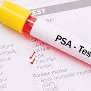 Imagen: Los pacientes con enfermedad inflamatoria intestinal que tienen un PSA elevado, pueden tener riesgo de cáncer de próstata (Fotografía cortesía de la Universidad de Harvard).