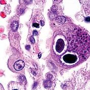 Imagen: Una histopatología de la infección por citomegalovirus en el pulmón que muestra inclusiones típicas de ojo de búho; la FDA aprueba la nueva prueba de CMV para recién nacidos (Fotografía cortesía de Danny Wiedbrauk, PhD).