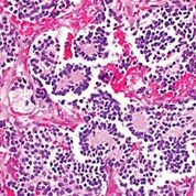 Imagen: Histopatología de un neuroblastoma típico con formación de rosetas (Fotografía cortesía del Dr. Mark Applebaum, MD).