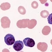 Imagen: Un frotis de sangre periférica de un paciente con leucemia de células plasmáticas que muestra cuatro células plasmáticas y la formación de eritrocitos en rouleaux (Fotografía cortesía de Tsuyako Saito).