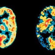 Imagen: Los exámenes de tomografía por emisión de positrones (TEP) del cerebro de un paciente normal (izquierda) versus un paciente con enfermedad de Alzheimer, que se podría haber detectado anteriormente al medir la cadena liviana del neurofilamento (NfL) en el LCR (Fotografía cortesía de Science Photo Library).