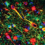 Imagen: Gingipains de Porphyromonas gingivalis en las neuronas del cerebro de un paciente con Alzheimer. Gingipains de P. gingivalis = rojo, neuronas = amarillo, astrocitos = verde (Fotografía cortesía de Cortexyme).